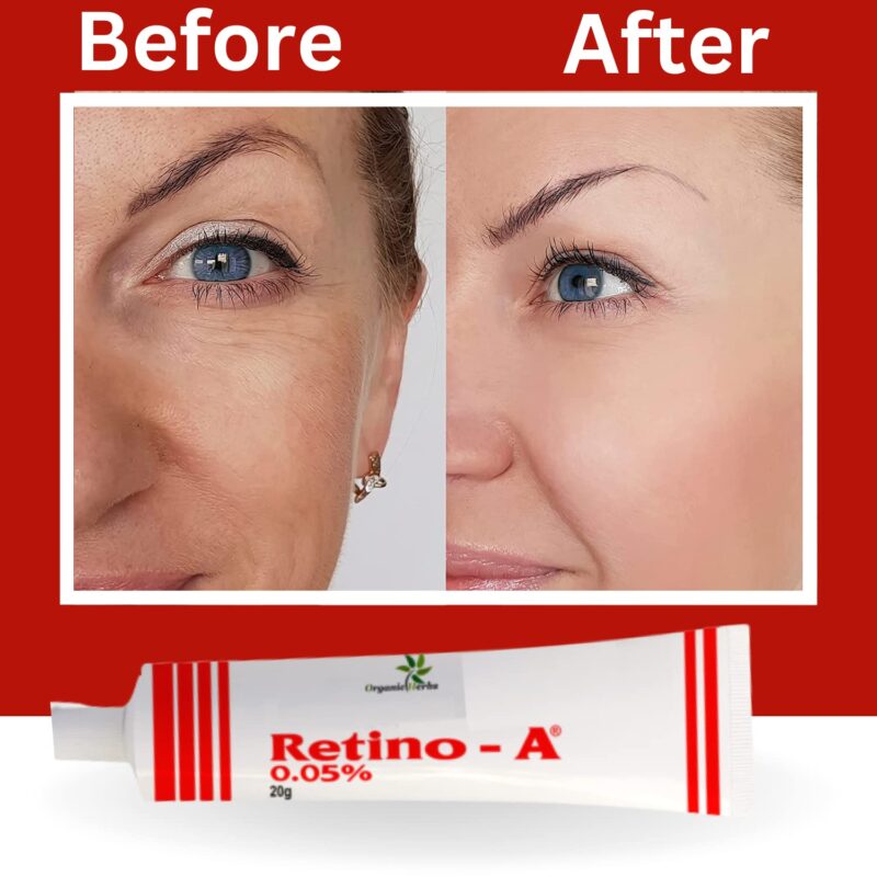 Cream Retino A, anti-aging skincare product.