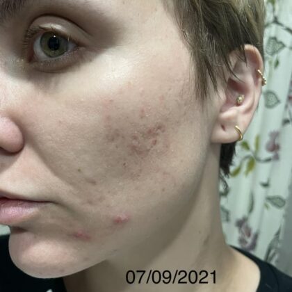0.05% Tretinoin cream tube