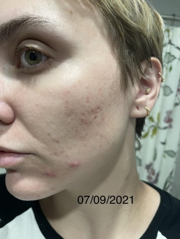 0.05% Tretinoin cream tube