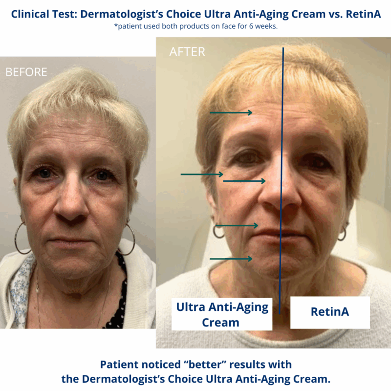 Tretinoin cream for anti-aging, skincare.