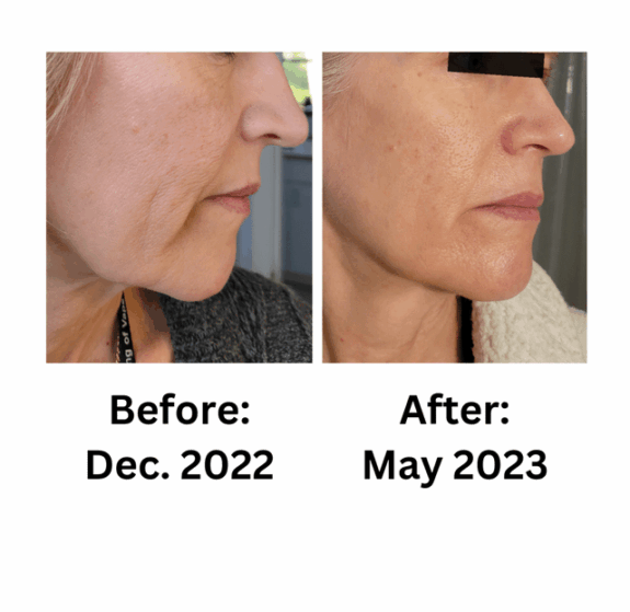 Tretinoin skin tightening cream.