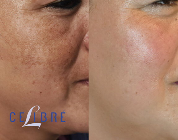 Hydroquinone treatment: before & after photos showing reduced freckles.