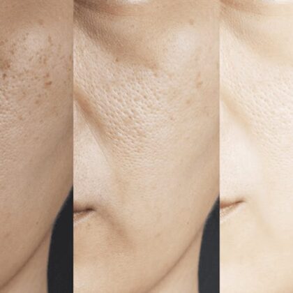 4% Hydroquinone Cream: Before & After skin treatment results.