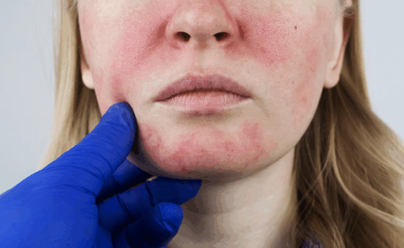 Hydroquinone Plus Cream: Side Effects information.