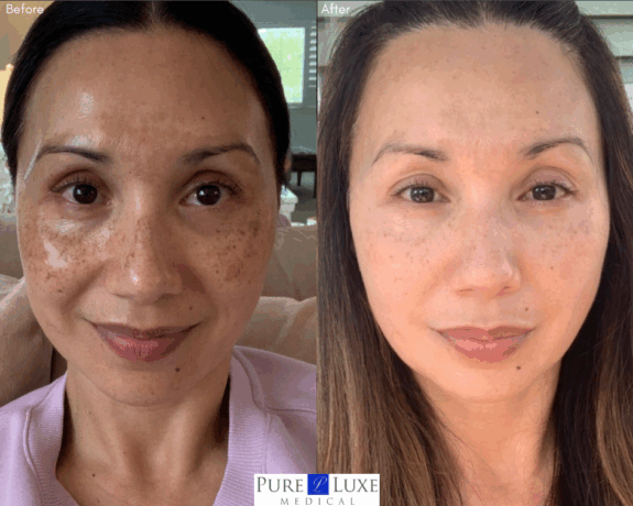 Zo Pigment Control Cream: Before & After skin improvement.
