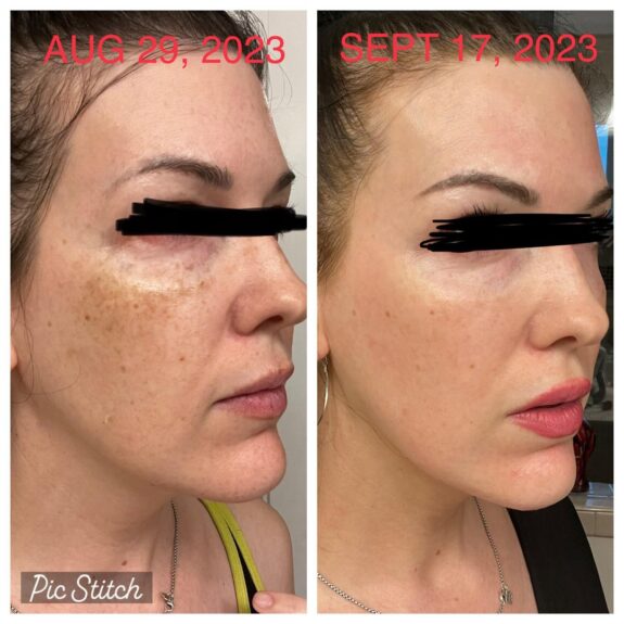 Before & after photos showing skin improvement with Reddit-recommended hydroquinone.
