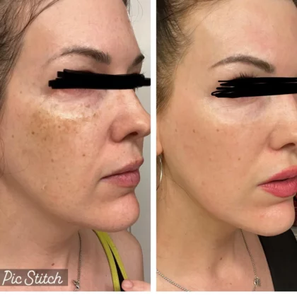Nandilone Hydroquinone cream tube.
