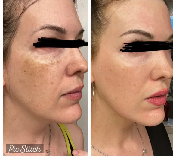 Nandilone Hydroquinone cream tube.