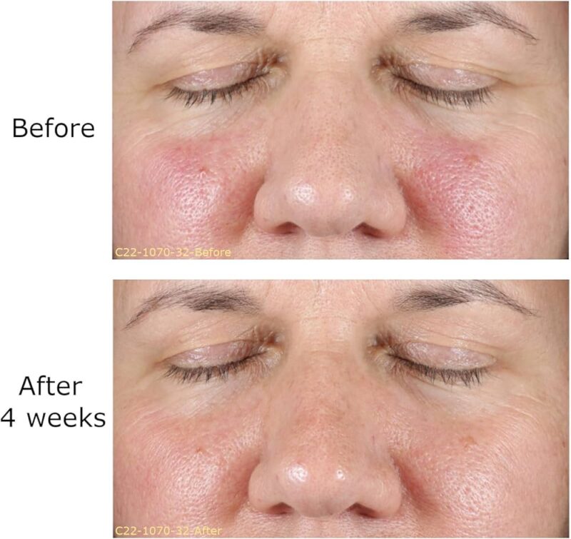 Tretinoin Cream 0.025% before & after results.