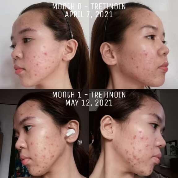 Tretinoin Uglies Reddit: Before & After photos showcasing skin changes during tretinoin use.