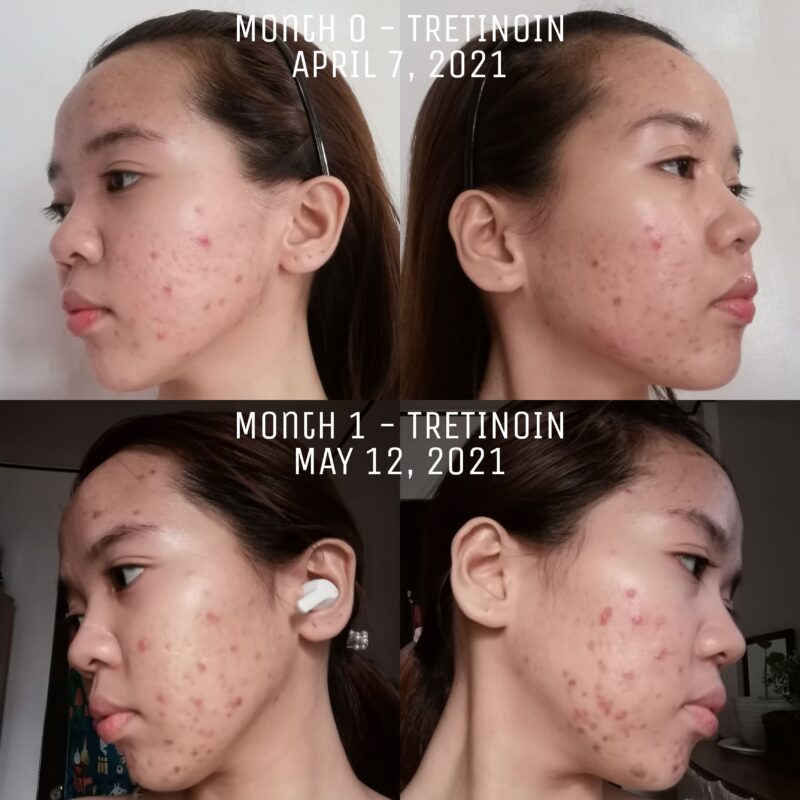 Tretinoin Uglies Reddit: Before & After photos showcasing skin changes during tretinoin use.