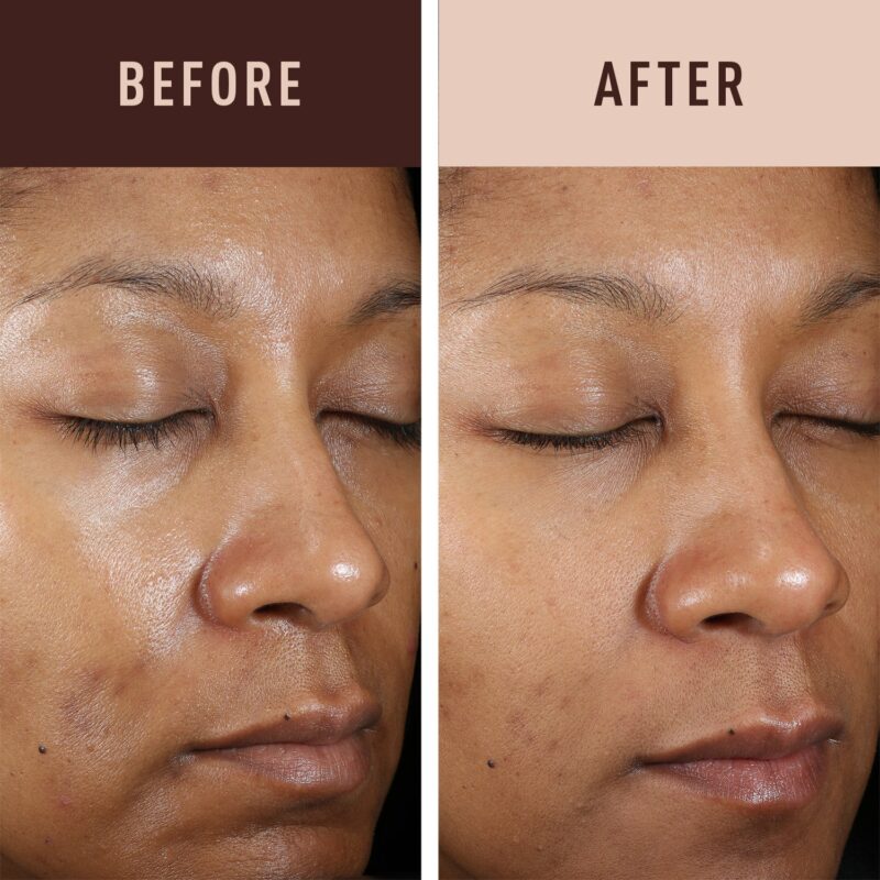 Hydroquinone cream before & after: showing skin improvement.
