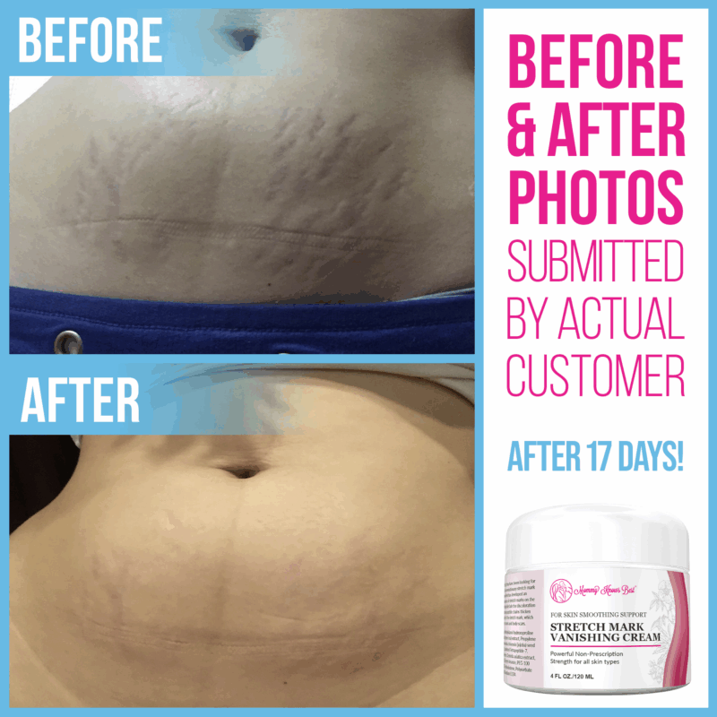 Tretinoin cream before & after stretch mark treatment.