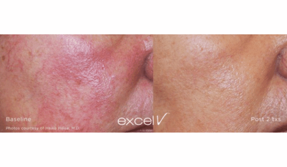 Hydroquinone cream for redness reduction.