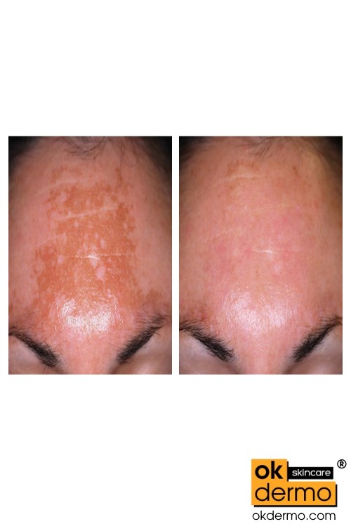 Melacare Hc Cream tube