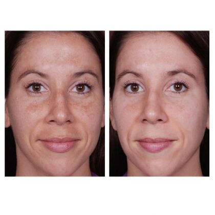 Melalite before & after: showing skin tone improvement.