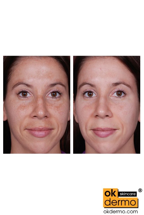 Melalite before & after: showing skin tone improvement.