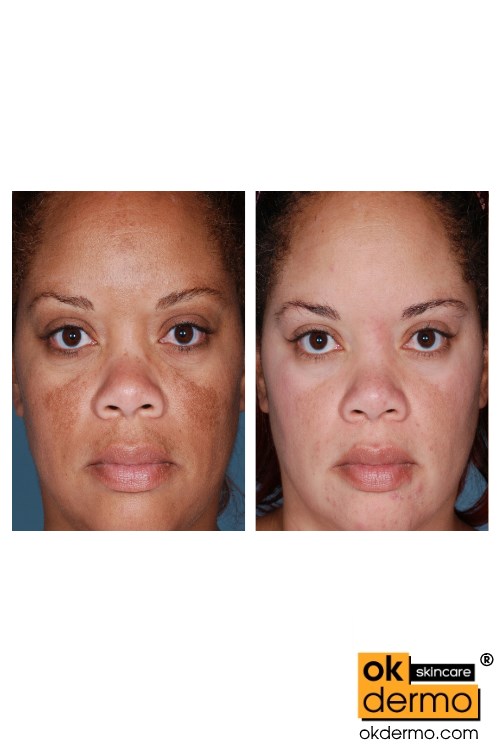 Hydroquinone Whitening cream or serum.