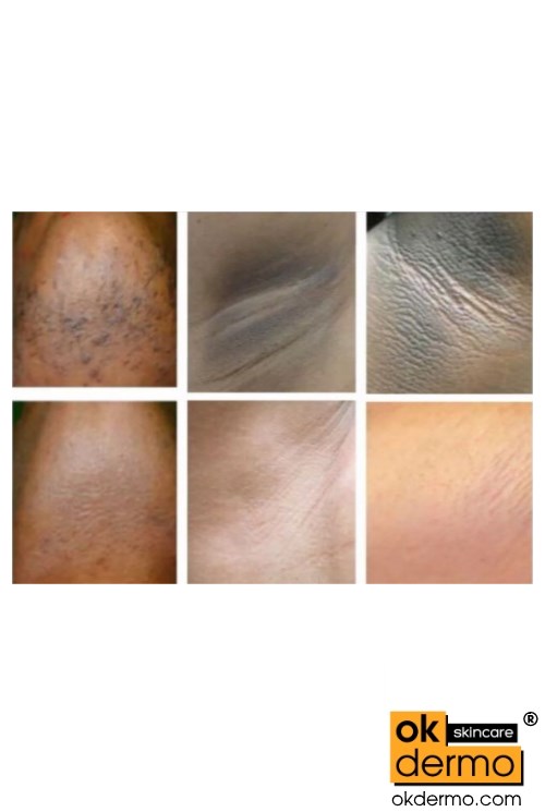 Hydroquinone cream for bikini area skin lightening.