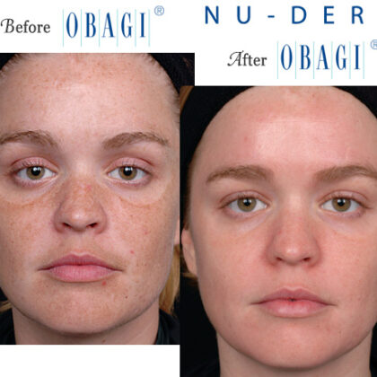 Obagi Tretinoin before & after: showing improved skin texture and tone.