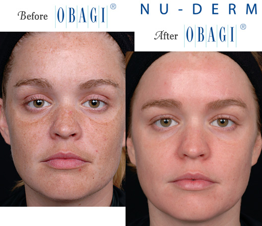 Obagi Tretinoin before & after: showing improved skin texture and tone.