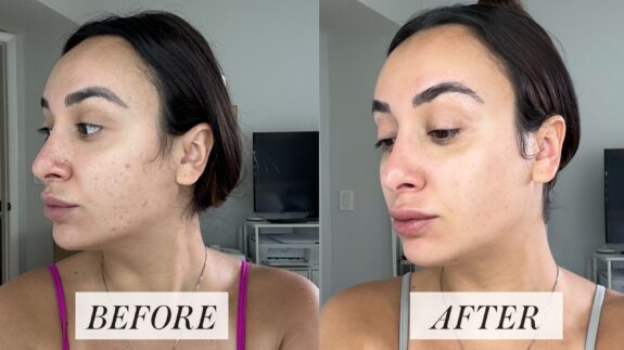 Tretinoin before & after: showing improved skin texture and tone.