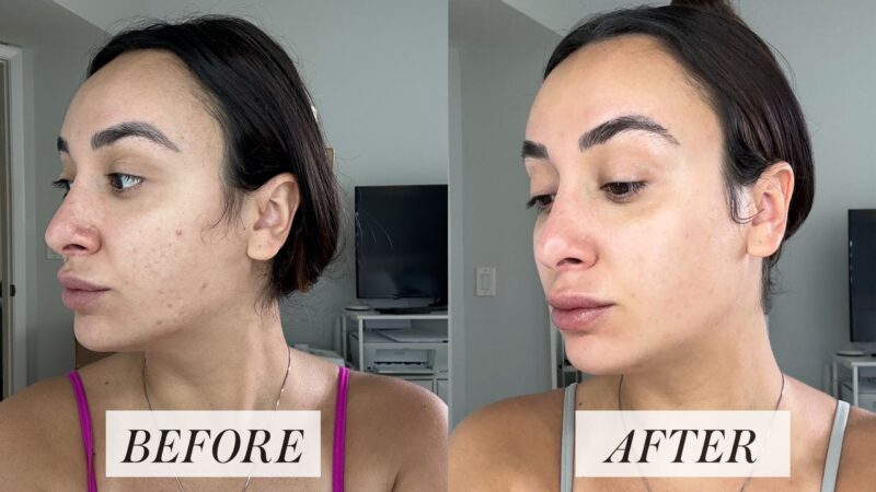 Tretinoin before & after: showing improved skin texture and tone.