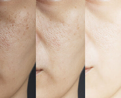 Hydroquinone skin treatment product.