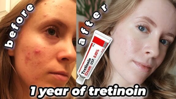 Tretinoin 0.05% gel before & after results.