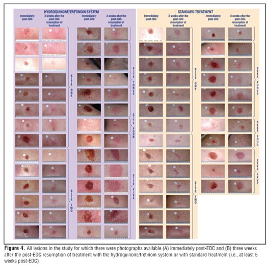 Hydroquinone Cream 3%, skin lightening cream.