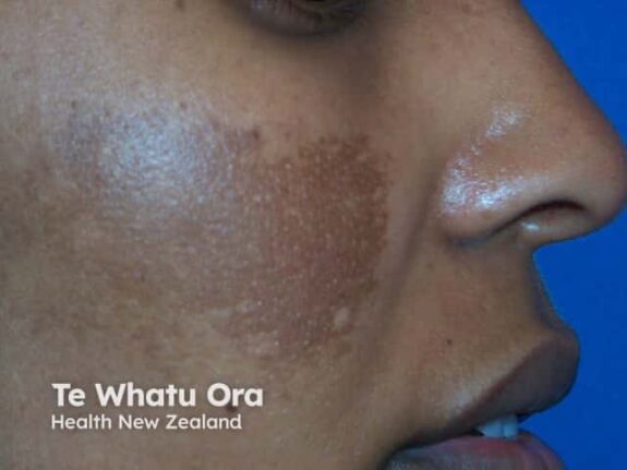 Hydroquinone cream side effects treatment.