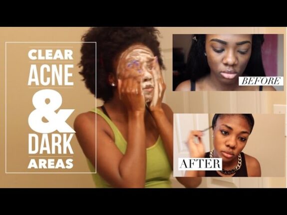 Tri Luma skin lightening cream for African American skin.