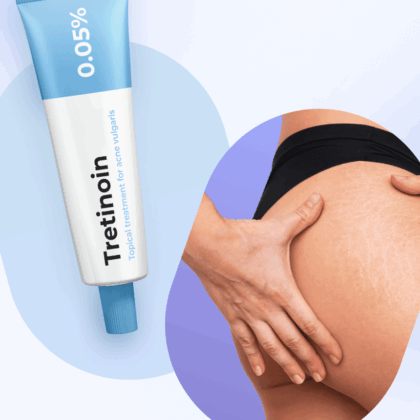 Tretinoin cream for stretch marks.