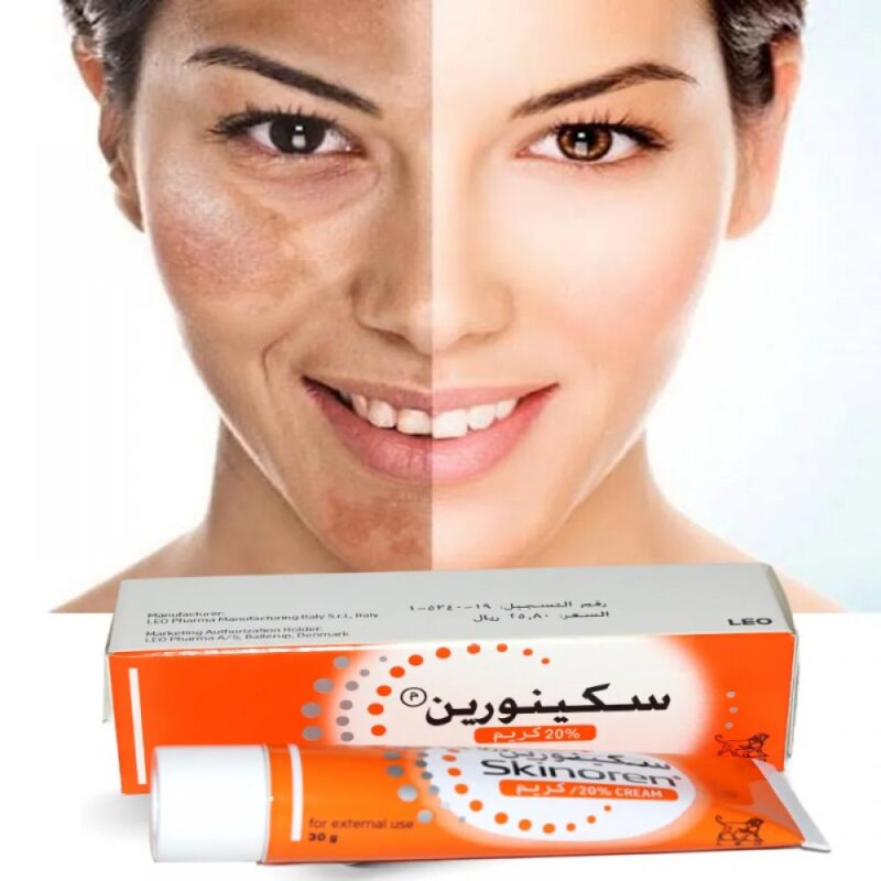 Skinoren cream for pigmentation treatment.