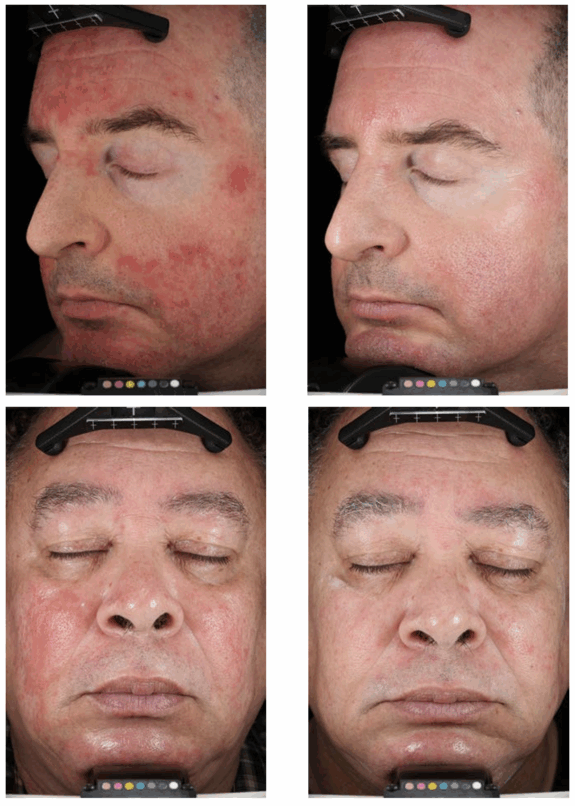 Azelaic acid serum for rosacea treatment.