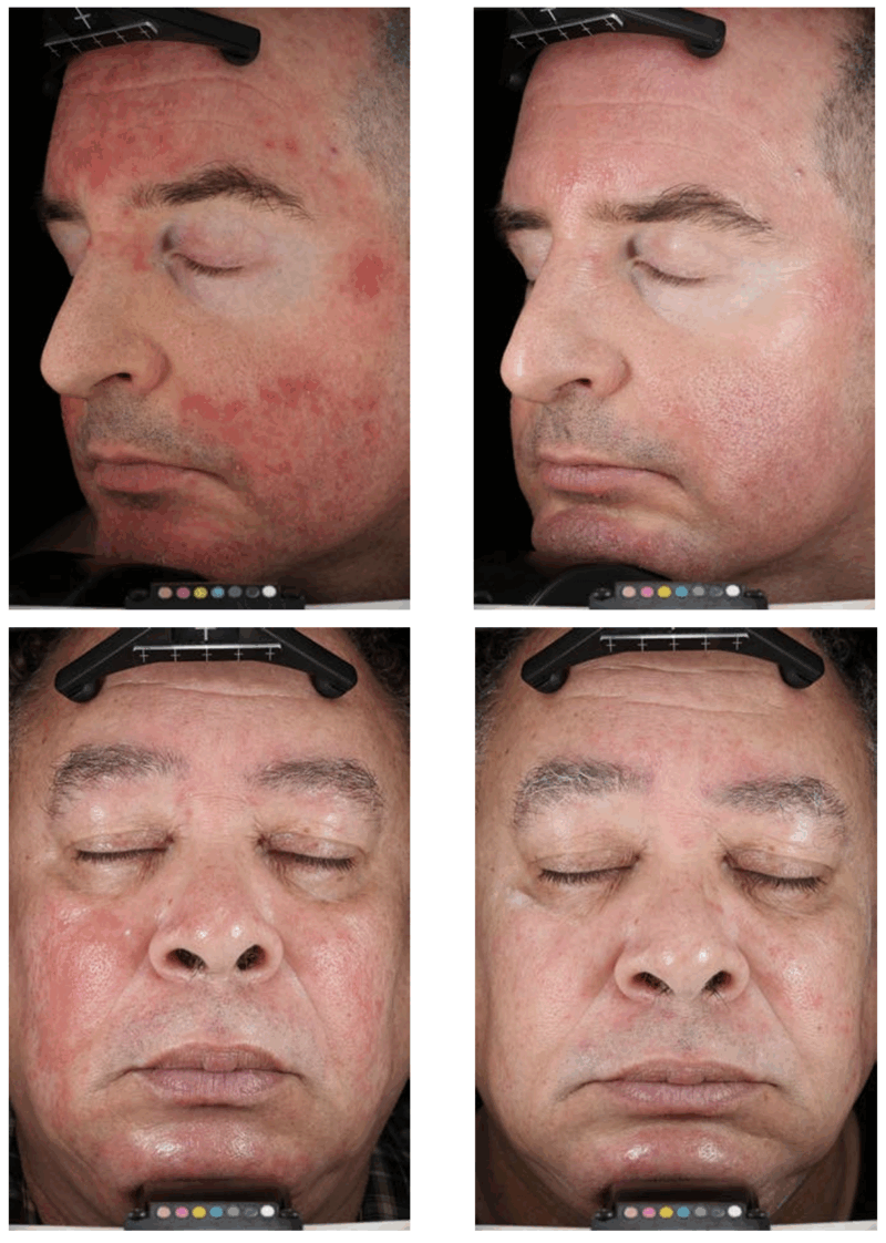 Azelaic acid serum for rosacea treatment.