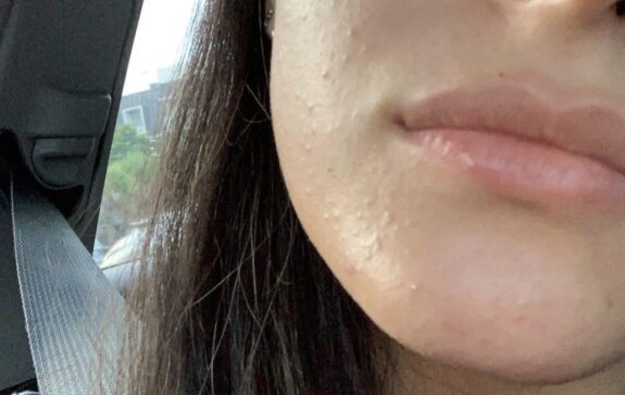 Azelaic acid treatment for closed comedones.