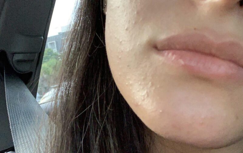 Azelaic acid treatment for closed comedones.