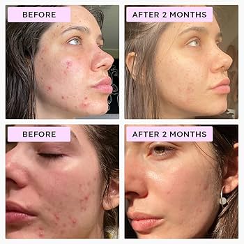 Azelaic acid treatment for blackheads.
