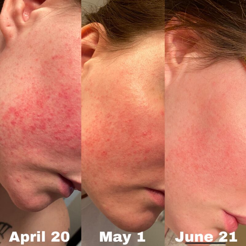 The Ordinary Azelaic Acid Suspension 10% - product image