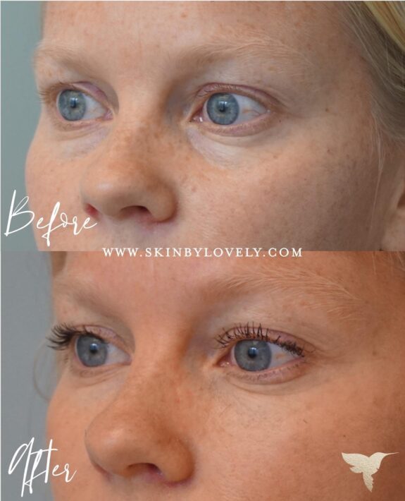 Azelaic acid under eye cream for dark circles.