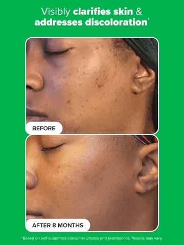 Azelaic Acid Booster: Before & After skin improvement.