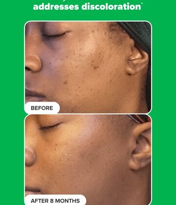 Paula's Choice Azelaic Acid before & after treatment results.
