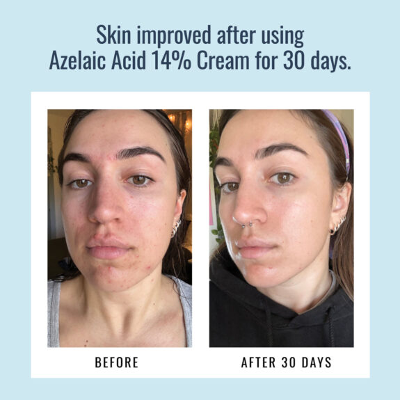 Azelaic Acid Facial Hair Removal Cream