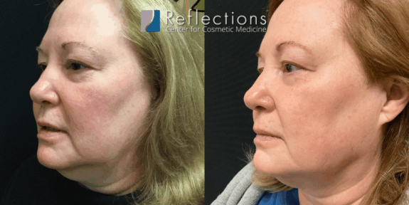 Finacea before & after: Clear skin improvement.