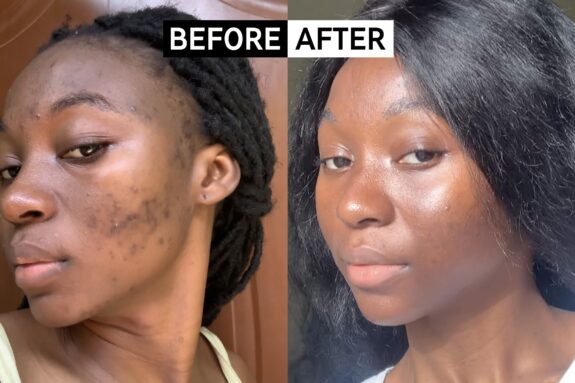 Azelaic acid before & after: reduced hyperpigmentation.