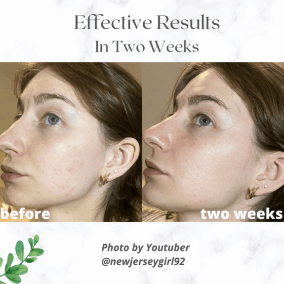 Zealsea Azelaic Acid serum bottle
