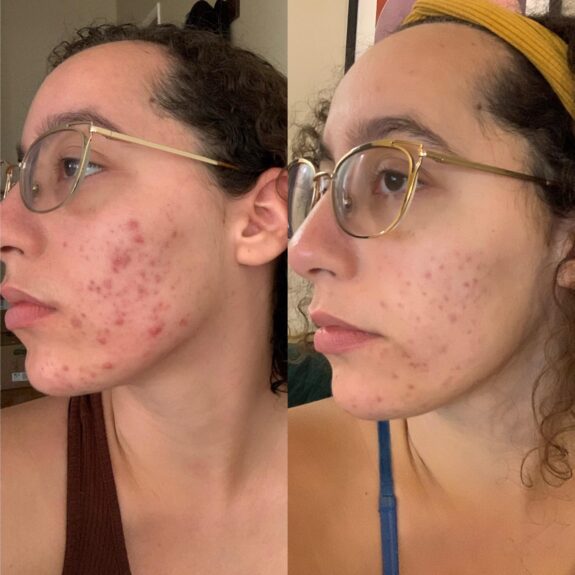 Azelaic acid and tretinoin serum.