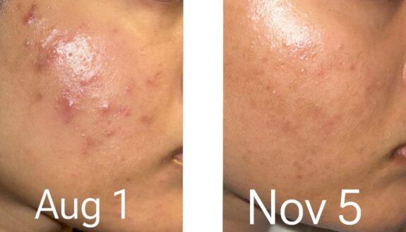 Azelaic & Tranexamic Acid serum bottle.