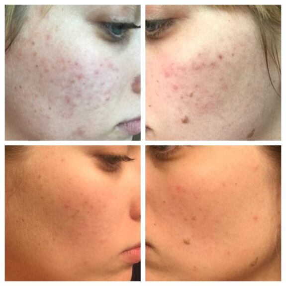 Azelaic Acid Suspension 10% - The Ordinary.